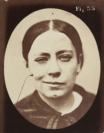 DE BOULOGNE DUCHENNE (1806 - 1875) Tavola n.35 dell'opera Mécanisme de la...